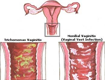 Candida Treatment Natural